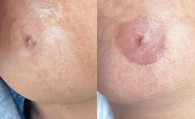 Rekonstruktion der Areola mittels Pigmentierung